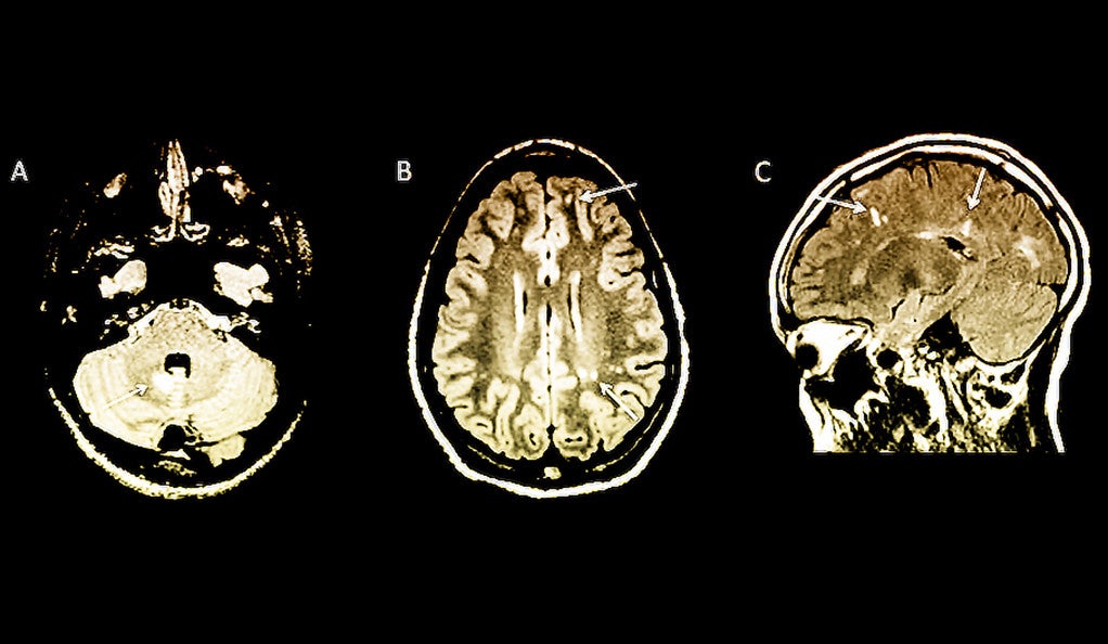 Three MRI scans of the human brain.