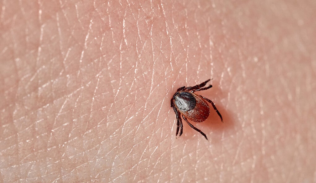 A tick embedded in human skin.