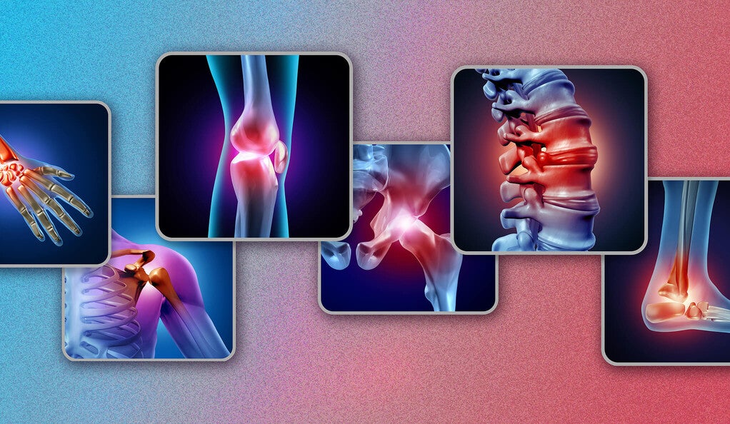 X-ray images of arthritis on various joints