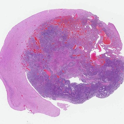 Image of a glioblastoma cell