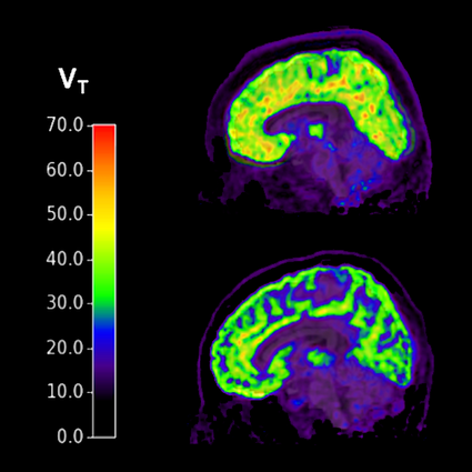 Brains of individuals with PTSD and suicidal thoughts (top) show higher levels of mGluR5 compared to healthy controls (bottom).