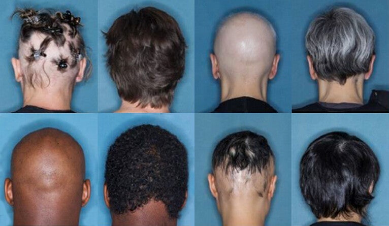 New trials for alopecia areata treatment are a success | YaleNews